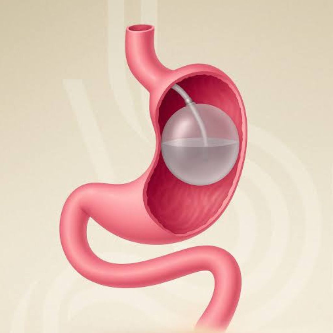 BALON GASTRICO.jpg